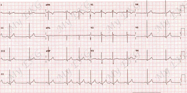 Electrocardiograma de la Arritmia Sinusal Respiratoria