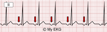 Electrocardiograma de Taquicardia Auricular