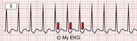 Electrocardiograma de Taquicardia Intranodal Atípica