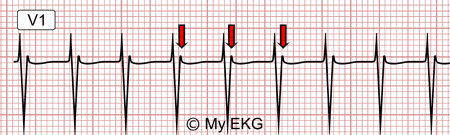 Electrocardiograma de Taquicardia Intranodal Típica
