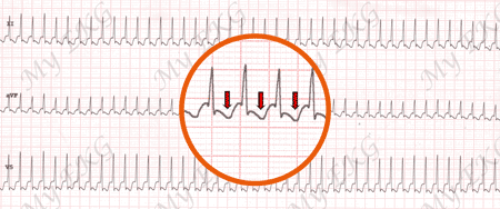 Electrocardiograma de Taquicardia Ortodrómica por vía accesoria