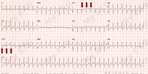 Electrocardiograma de Taquicardia Intranodal Típica