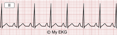 Electrocardiograma de Taquicardia Sinusal