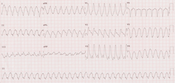 Electrocardiograma de Taquicardia Ventricular Monomórfica