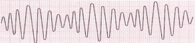 Electrocardiograma de Torsades de Pointes