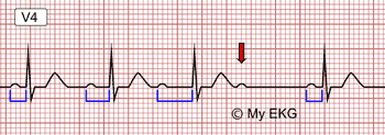 Bloqueo Auriculoventricular de Segundo Grado Tipo I o Wenckebach