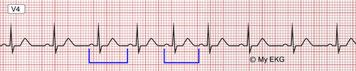 Sinus Arrhythmia