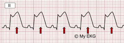 Elévation du segment ST dans l’infarctus aigu