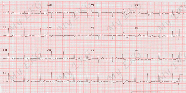 Fénomeno de Ashman en el Electrocardiograma