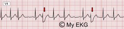 Electrocardiogram Findings of the Ashman Phenomenon