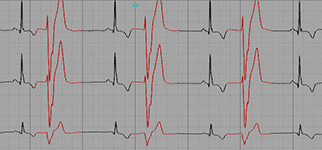 Ventricular Bigeminy