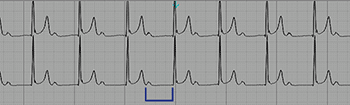 Electrocardiogram of First Degree Atrioventricular Block