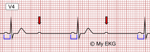 Bloqueio Atrioventricular de Segundo Grau Tipo 2:1