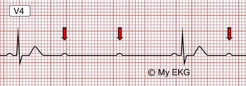 High-grade or Advance Second Degree AV Block