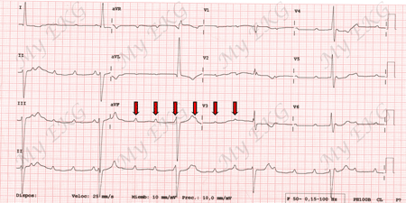 Electrocardiogram of Complete Atrioventricular Block