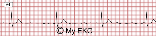 Atrial Fibrillation and Complet Atrioventricular Block