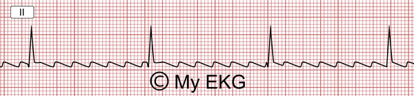 Flutter Atrial com Bloqueio Atrioventricular Completo