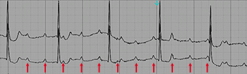 Third degree Atrioventricular Block, Complete AV Block