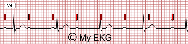 Bloqueio Atrioventricular de Terceiro grau, Bloqueio AV Completo