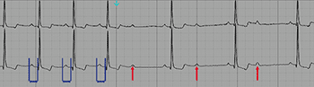 Bloqueio Atrioventricular de Segundo Grau, Mobitz II