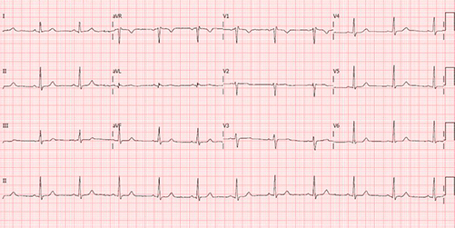 Electrocardiogram of Incomplete Right Bundle Branch Block