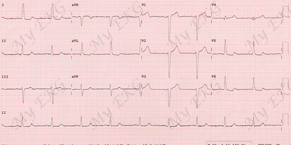 Electrocardiogram of Incomplete Left Bundle Branch Block