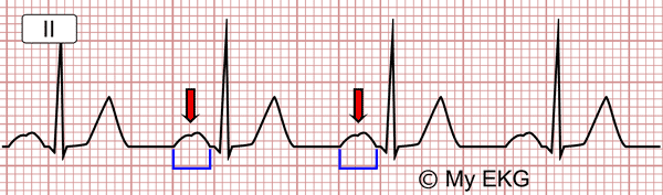 Eletrocardiograma do Bloqueio Interatrial Parcial