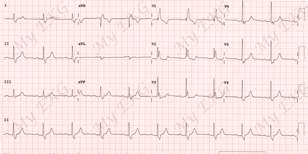 Bloqueo Completo de Rama Derecha en el Electrocardiograma