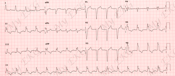 Electrocardiogram of Left Bundle Branch Block (LBBB)