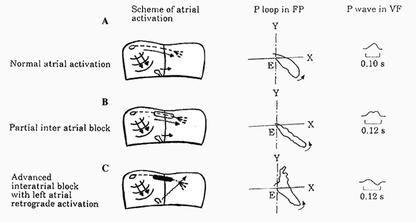 Atrial Activation of Interatrial Blocks