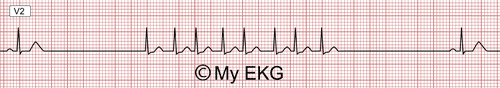 Bradycardia-Tachycardia Syndrome