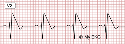 Électrocardiogramme du patron de Brugada type 1