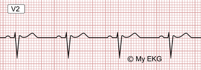 Électrocardiogramme du patron de Brugada type 3