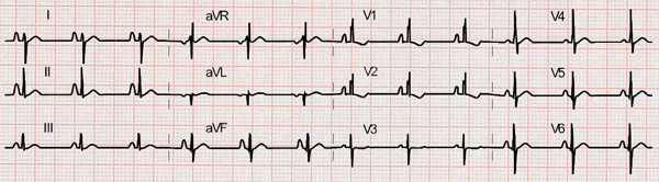 Electrocardiogram of Ostium Secumdum Atrial Septal Defect