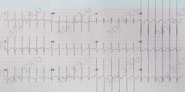 Eletrocardiograma de uma grande comunicação interventricular