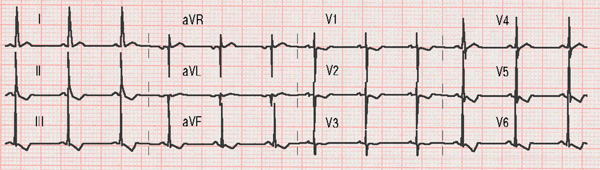 Electrocardiogram of a Ventricular Septal Defect