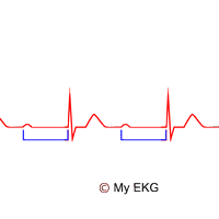 Alteraciones de las Ondas e Intervalos del EKG