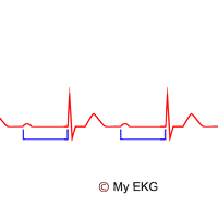 Abnormal Waves and Intervals