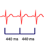 Determining Heart Rate