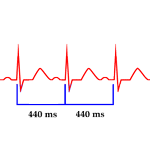 Cómo Calcular la Frecuencia Cardiaca de un Electrocardiograma