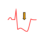 Análisis del Segmento ST del Electrocardiograma
