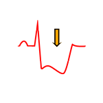 ST Segment abnormalities