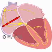 Right Atrial Enlargement