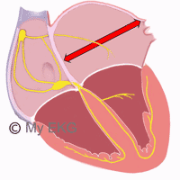 Dilatazione dell'atrio sinistro