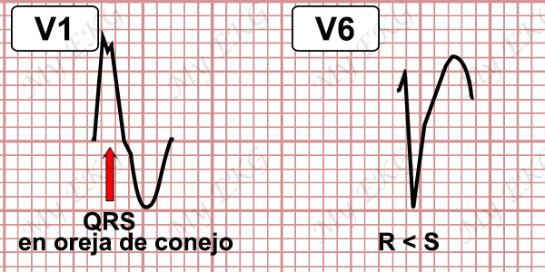 Criterios de Taquicardia Ventricular con Bloqueo de Rama Izquierda