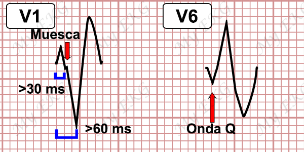 Criterios de Taquicardia Ventricular con Bloqueo de Rama Izquierda