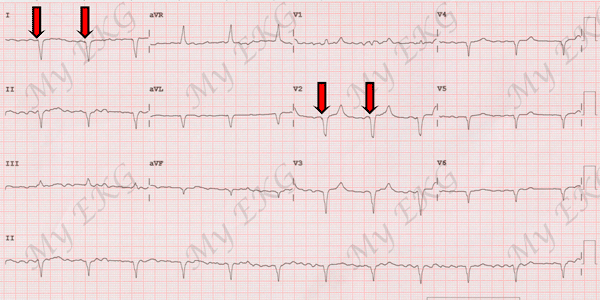 Extreme Axis Deviation due to Ventricular Pacing