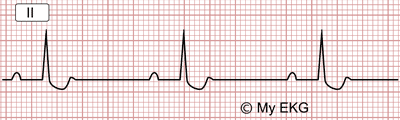 Electrocardiogram changes caused by Digoxin