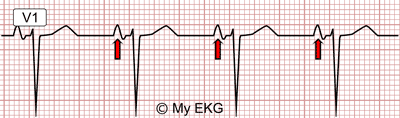 Right Atrial Enlargement in lead V1