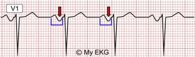 Right Atrial Enlargement in lead V1